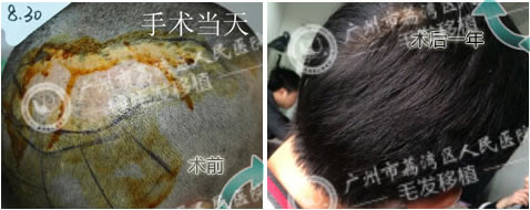 广州人民医院植发中心为疤痕青年成功植发