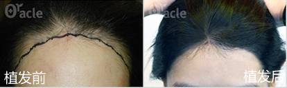 韩国奥拉克毛发移植中心女性发际线调整效果