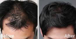 上海艺星毛发移植中心男性头发加密手术案例