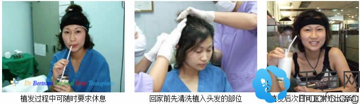 上海申江医院植发中心帮助Sara成功植发手术过程
