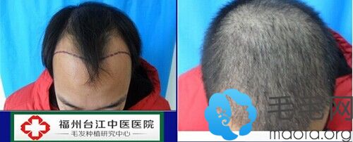 福州台江中医院毛发种植中心为患者植发两年后效果