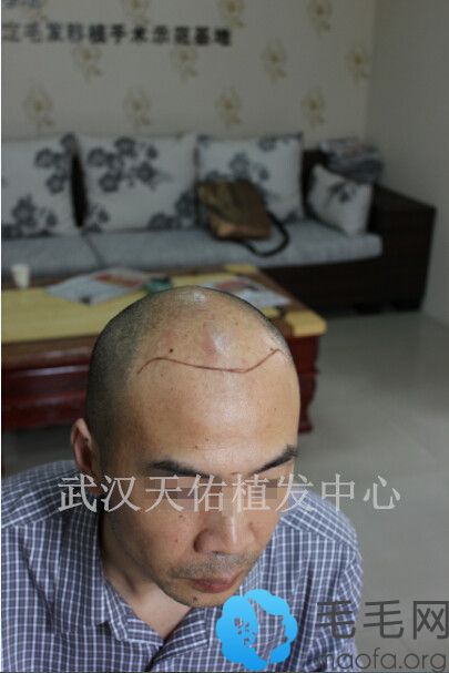郭先生在武汉天佑植发中心植发前的设计图