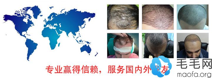 南宁发之源毛发种植中心外国患者来院植发