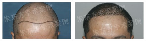 北京中美恒恩植发中心为张先生七级脱发植发案例