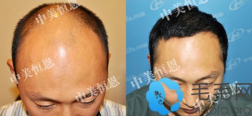 北京中美恒恩植发中心朱东方为男性患者植发