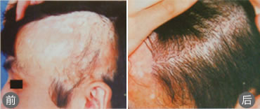 西安西医植发案例 男性疤痕植发手术