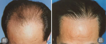 西安西医植发案例 Ⅳ级脱发患者接受手术