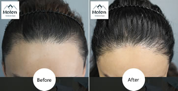 韩国毛腾毛发移植医院案例 女性头顶植发1500毛囊