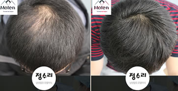 韩国毛腾毛发移植案例 头顶脱发植发1400毛囊