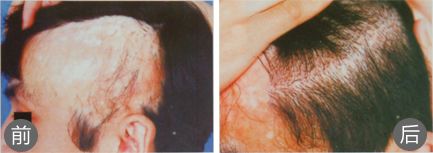 西安西医植发为男性疤痕植发手术一年后的效果
