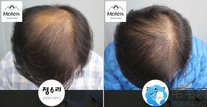 头顶脱发患者在毛腾毛发移植医院种植1800毛囊手术2年后效果