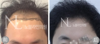 韩国Noble Line植发男性秃顶植发案例