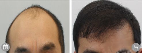 韩国Noble Line植发男性患者植发案例术前术后效果对比