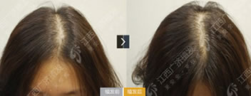 江西广济医院植发案例 女性头缝宽实施头发加密手术