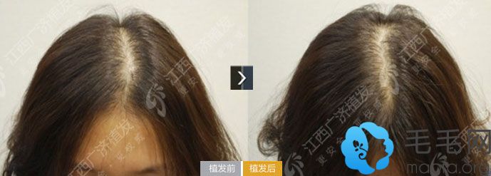 江西广济医院植发案例 女性头缝宽实施头发加密手术两年后效果