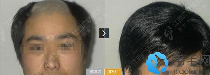 江西广济医院毛发移植案例 重塑线际线+头发加密一年后的效果