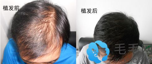 太原长城医学植发案例 男性头发加密手术前后效果对比