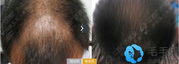 江西广济医院毛发移植案例 卷发移植+头发加密手术十个月效果