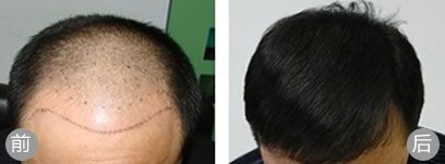 呼和浩特伊思植发案例 男性秃顶实施植发手术一年后效果