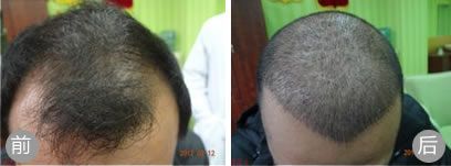 内蒙古伊思植发案例之男性前额脱发进行植发治疗