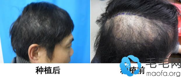 植发手术来治疗斑秃效果对比