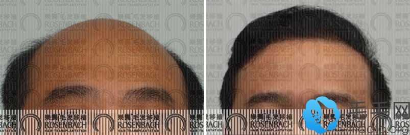 广州乐鬓植发案例之植发手术治疗秃顶