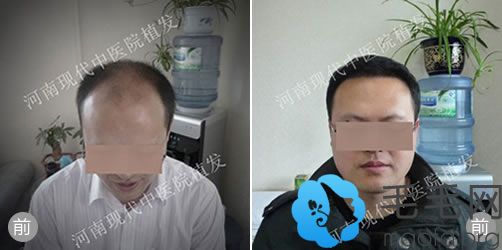 郑州现代中医院植发案例之男性治疗秃顶效果