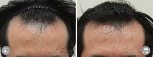 韩国安医生毛发移植案例 男性前额植发手术前后效果对比