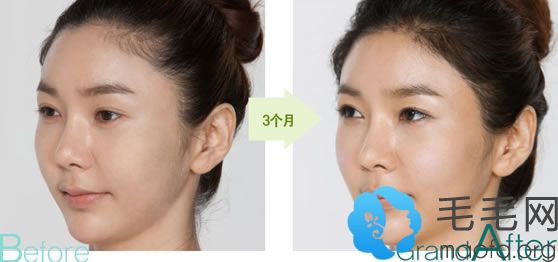 韩国高兰得3D女性植发术治疗脱发3个月后效果