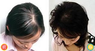 徐州有美植发为头部生疮感染患者进行疤痕修复手术