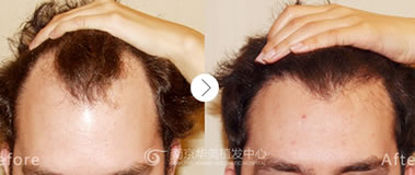南京华美植发案例 男性M型脱发植发手术