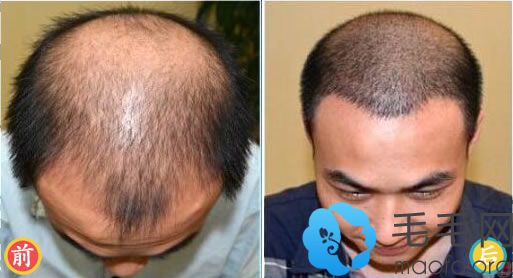 徐州有美植为患者植发解决头发稀疏烦恼