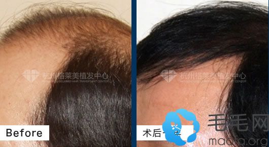 杭州格莱美通过植发治疗前额头顶大面积脱发