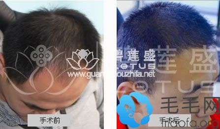 广州碧莲盛植发实施头发稀疏加密手术