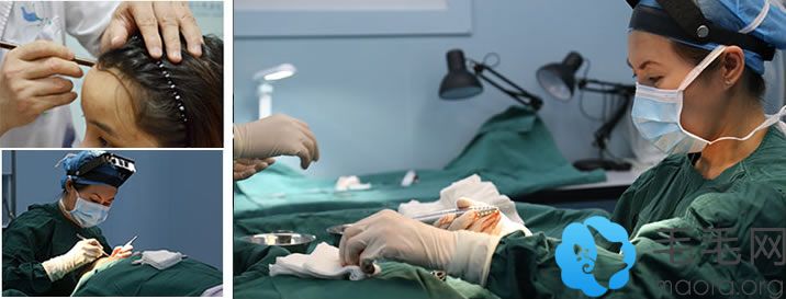 北京美莱毛发移植中心董海英正在植发手术