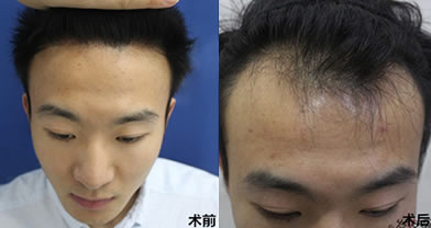 重庆重生发际移植案例 植发治疗脂溢性脱发