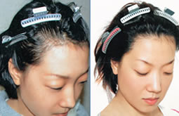 石家庄博士园植发案例 女性头发加密植发手术
