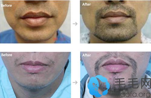 胡须移植手术前后效果对比