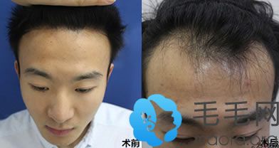 重庆重生发际移植案例 植发治疗脂溢性脱发