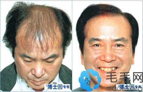 石家庄博士园植发治疗男性秃顶手术