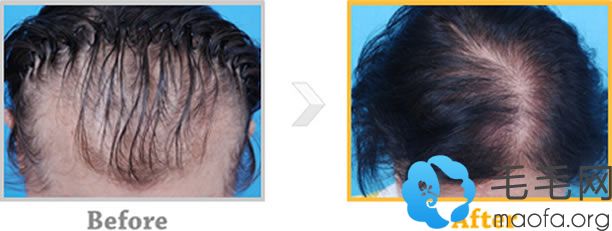 韩国毛爱林植发手术治疗女性型脱发