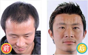 青岛瑞丽诗植发案例 男性秃顶MHT精细化植发