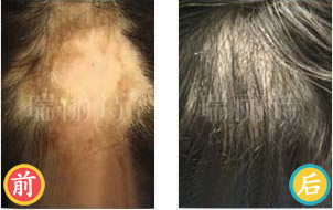 青岛植发案例 NTE不剃发技术修复女性疤痕