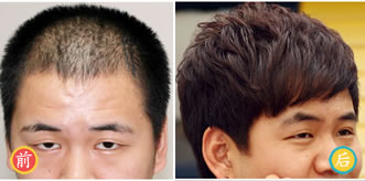广州雍禾植发案例 植发治疗脂溢性3级脱发