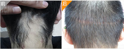 贵阳丽都植发案例 男性头发稀少选择植发手术