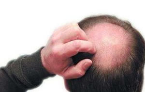 植发治疗脱发秃顶的效果真的是的吗？