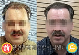 韩国黄盛柱植发案例 植发治疗50岁男性的M型脱发