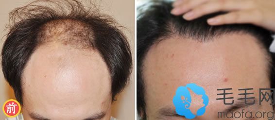 7级脂溢性脱发患者选择广州雍禾进行植发治疗