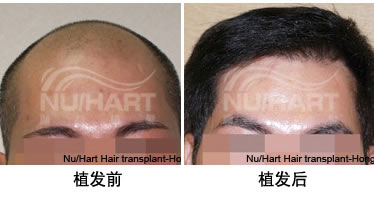 香港显赫植发案例 男性秃顶选择植发手术