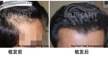 香港显赫植发案例 男性发际线修复手术效果